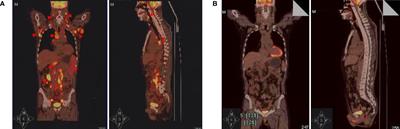 CD19 CAR-T Cell Therapy Induced Immunotherapy Associated Interstitial Pneumonitis: A Case Report